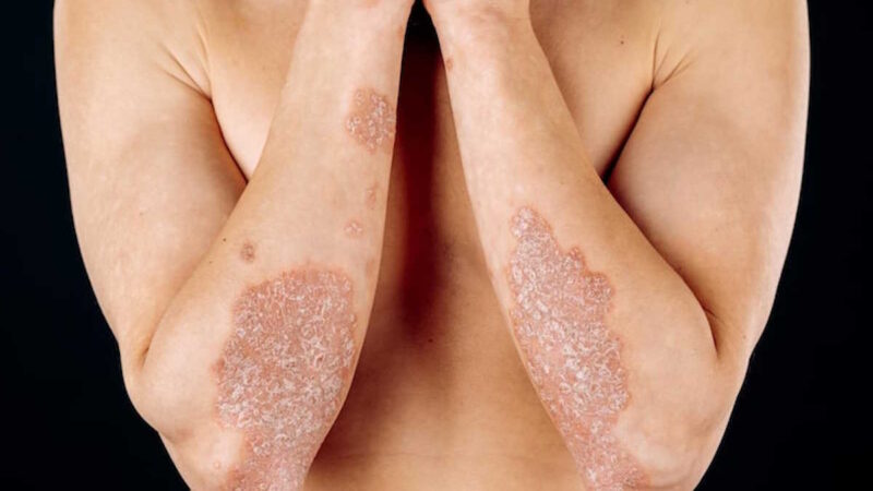 Du Lichen Plan sur des bras d'une femme