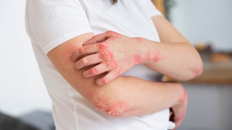 Une femme qui a de la Psoriasis sur les mains et les coudes