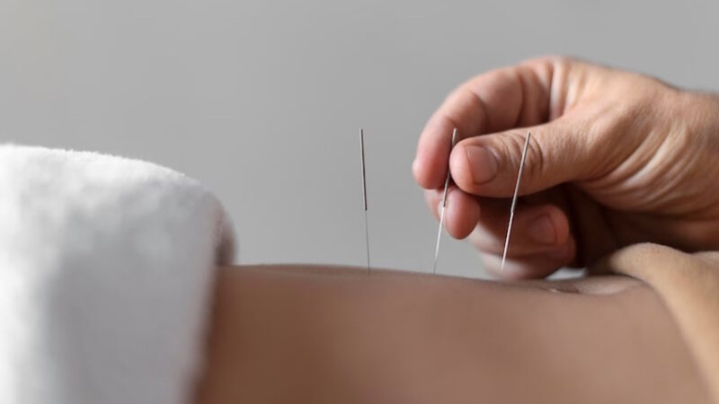 acupuncture